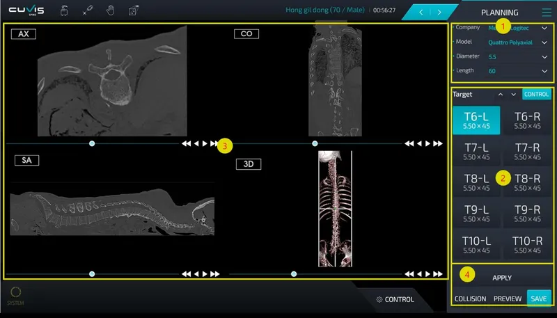Màn hình phần mềm lập kế hoạch đường vít trên ảnh CT của CUVIS-spine